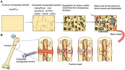 Limitations and modifications in the clinical application of calcium sulfate